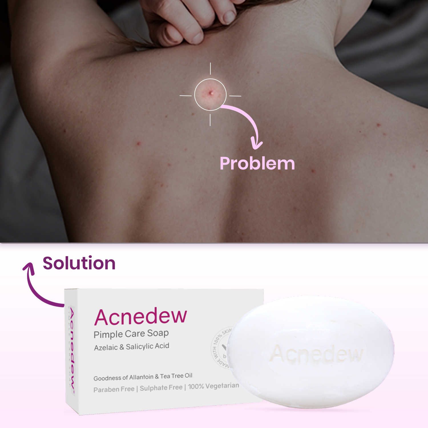 Acnedew Soap - Image 6